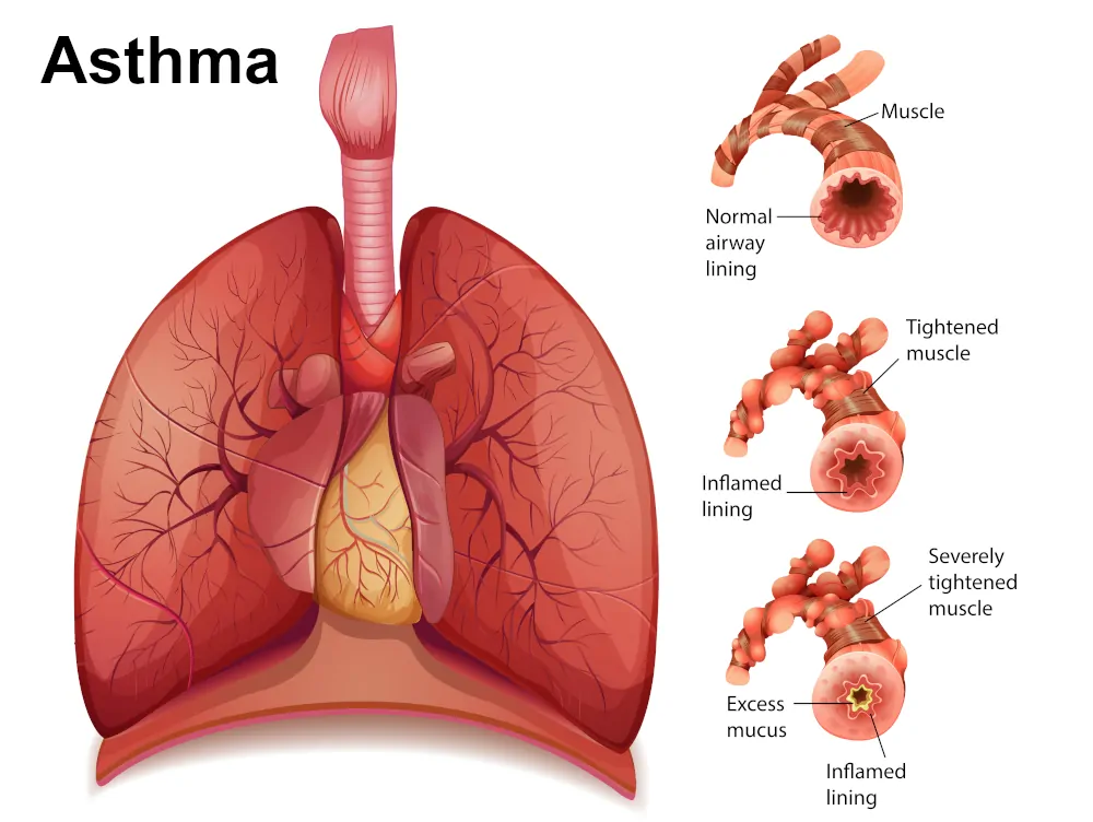 Asthma The Ayurvedic Concept Ayurvedic Clinic