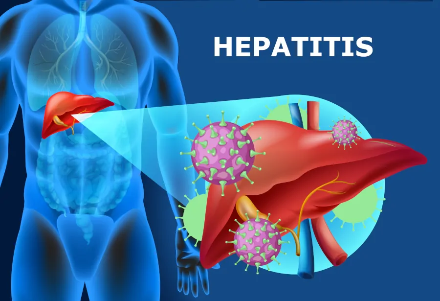 Hepatitis: The Ayurvedic Concept - Ayurvedic Clinic